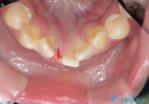 [ 下顎3前歯の矯正治療 ]  3インサイザー仕上げのマウスピース矯正の治療前