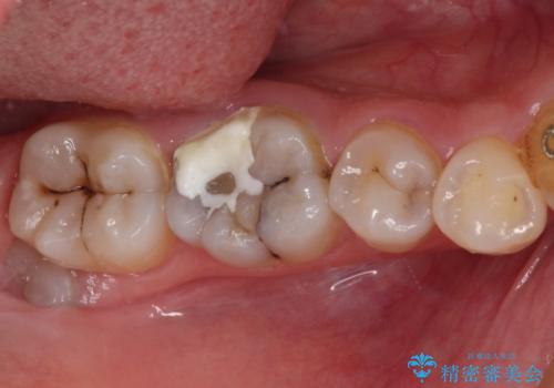 放置した虫歯　根管治療とオールセラミッククラウンの治療前