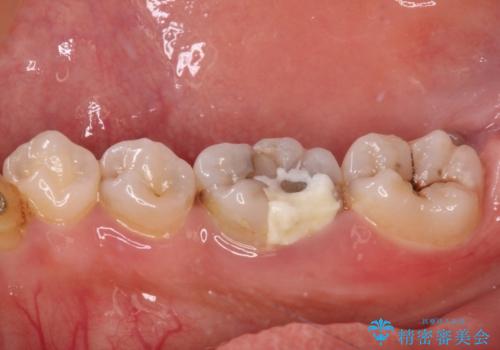 放置した虫歯　根管治療とオールセラミッククラウンの治療前