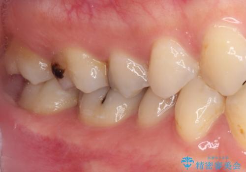 放置した虫歯　根管治療とオールセラミッククラウンの治療前