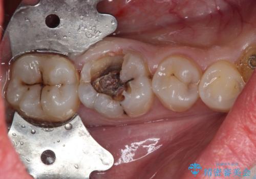 放置した虫歯　根管治療とオールセラミッククラウンの治療中
