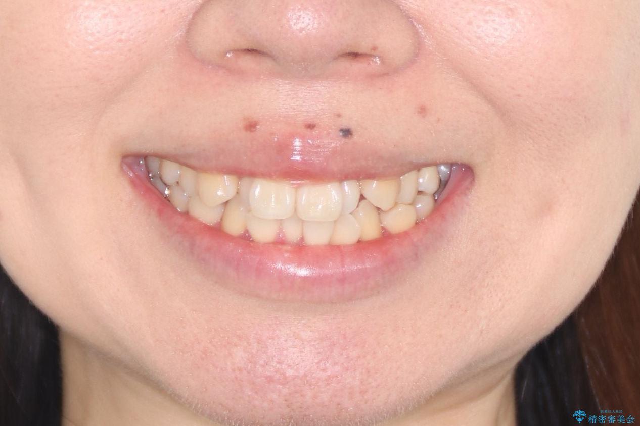 【難症例 インビザライン】抜歯+遠心移動ケースの治療前(顔貌)