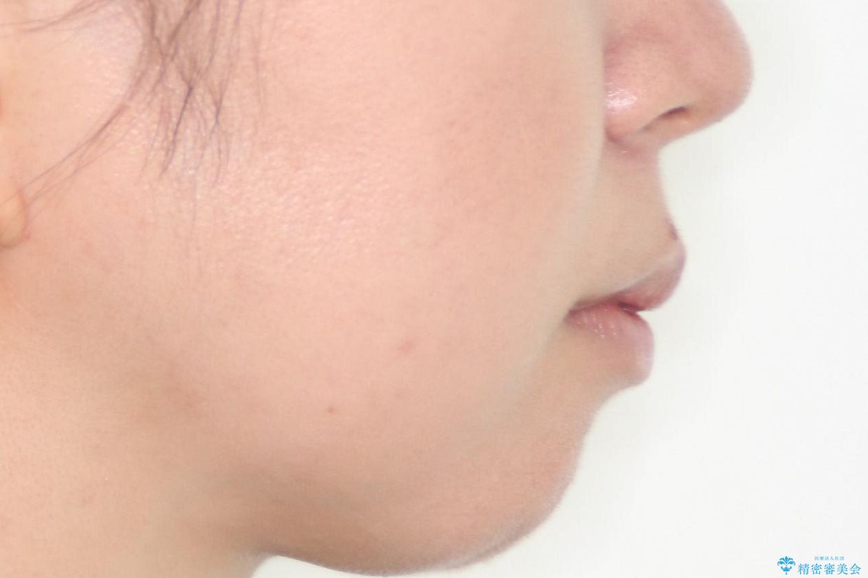 【難症例 インビザライン】抜歯+遠心移動ケースの治療前(顔貌)