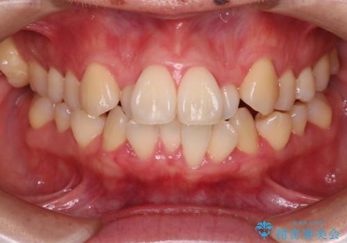 【難症例 インビザライン】抜歯+遠心移動ケースの治療前