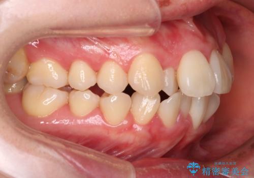 【難症例 インビザライン】抜歯+遠心移動ケースの治療前