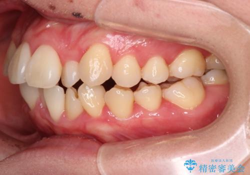 【難症例 インビザライン】抜歯+遠心移動ケースの治療前