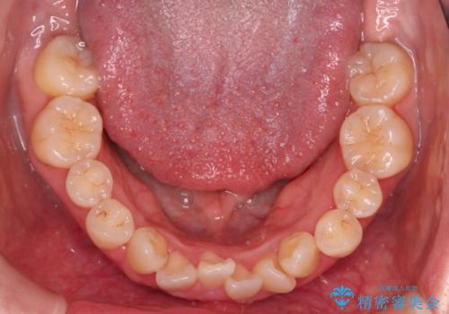 【難症例 インビザライン】抜歯+遠心移動ケースの治療前