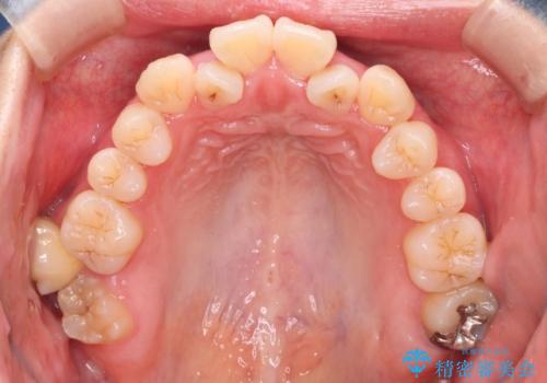 【難症例 インビザライン】抜歯+遠心移動ケースの治療前