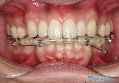 前歯の隙間を閉じたい 口元も下げたい ハーフリンガルによる抜歯矯正の治療中