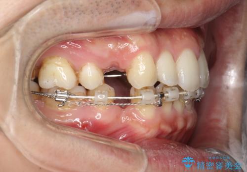 前歯の隙間を閉じたい 口元も下げたい ハーフリンガルによる抜歯矯正の治療中