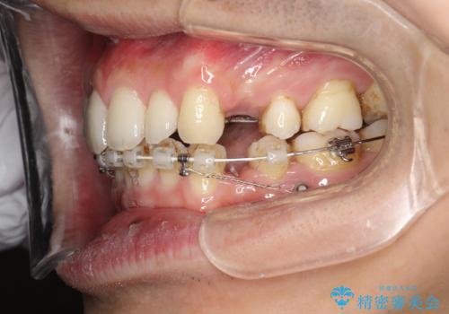 前歯の隙間を閉じたい　口元も下げたい　ハーフリンガルによる抜歯矯正の治療中