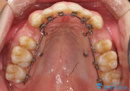 前歯の隙間を閉じたい 口元も下げたい ハーフリンガルによる抜歯矯正の治療中