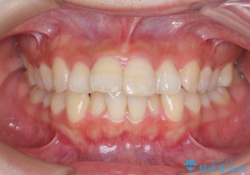 インビザラインで出っ歯の治療の症例 治療前