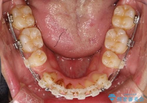 前歯の隙間を閉じたい　口元も下げたい　ハーフリンガルによる抜歯矯正の治療中
