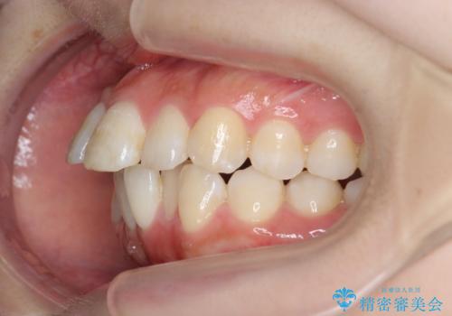 インビザラインで出っ歯の治療の治療前