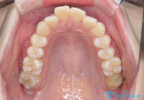 インビザラインで出っ歯の治療の治療前