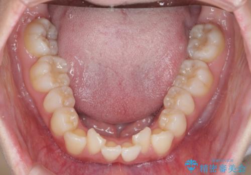 インビザラインで出っ歯の治療の治療前