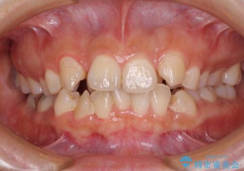 見えないほど重なっている前歯　抜歯矯正でスッキリとした歯並びにの症例 治療前