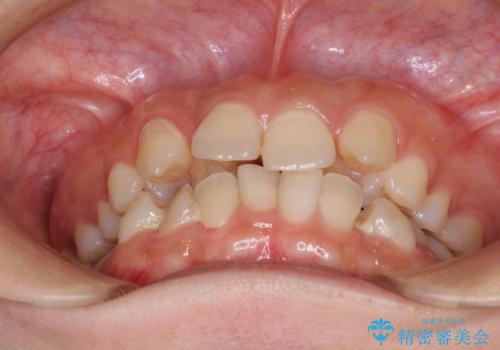 見えないほど重なっている前歯　抜歯矯正でスッキリとした歯並びにの治療前