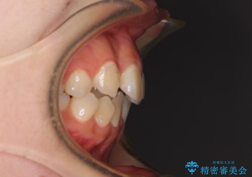 見えないほど重なっている前歯 抜歯矯正でスッキリとした歯並びにの治療前