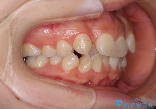 見えないほど重なっている前歯 抜歯矯正でスッキリとした歯並びにの治療前