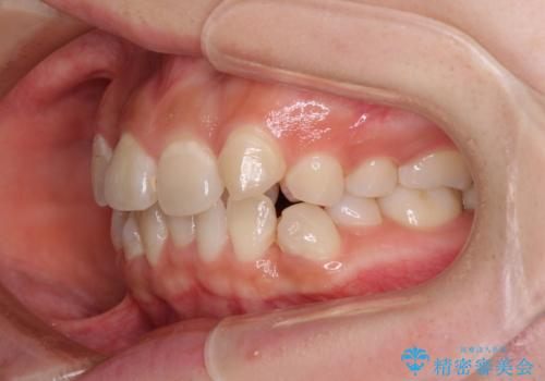 見えないほど重なっている前歯　抜歯矯正でスッキリとした歯並びにの治療前