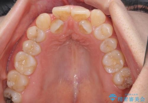 見えないほど重なっている前歯 抜歯矯正でスッキリとした歯並びにの治療前