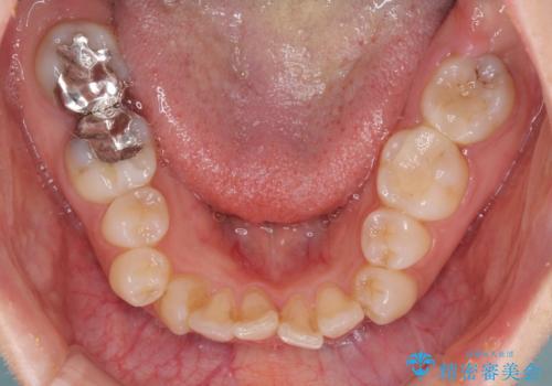 見えないほど重なっている前歯 抜歯矯正でスッキリとした歯並びにの治療前