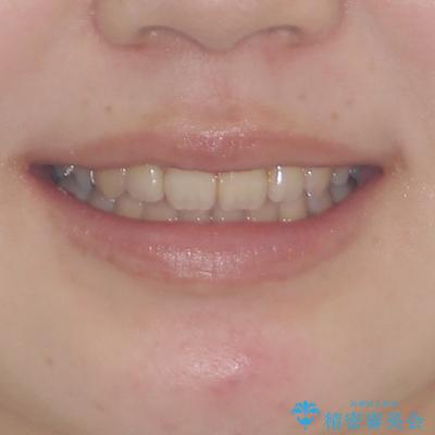 閉じにくい口元と八重歯　ワイヤー装置での抜歯矯正の治療後（顔貌）
