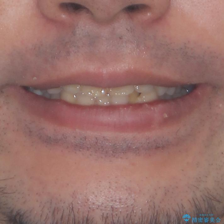 早くて安くて楽ちん メタルブラケットでの矯正治療の治療前(顔貌)