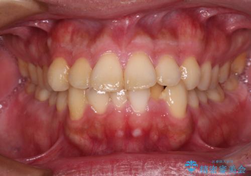 早くて安くて楽ちん メタルブラケットでの矯正治療の治療前