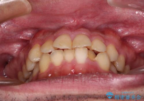 早くて安くて楽ちん メタルブラケットでの矯正治療の治療前