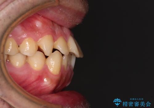 早くて安くて楽ちん メタルブラケットでの矯正治療の治療前