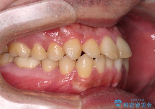 早くて安くて楽ちん メタルブラケットでの矯正治療の治療前