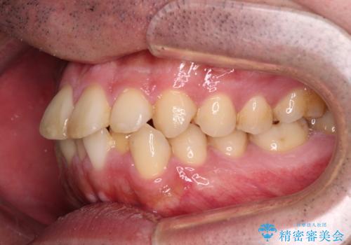 早くて安くて楽ちん メタルブラケットでの矯正治療の治療前