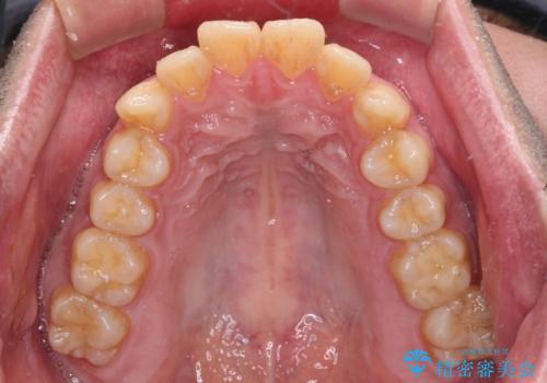 早くて安くて楽ちん メタルブラケットでの矯正治療の治療前