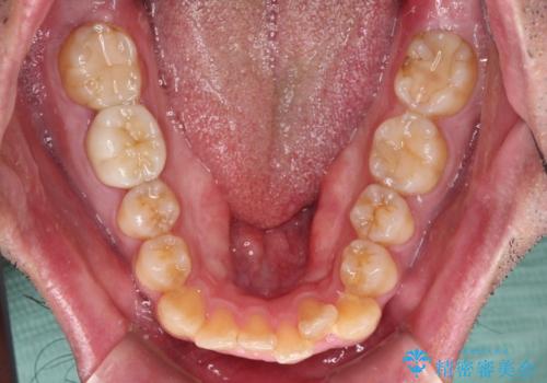 早くて安くて楽ちん メタルブラケットでの矯正治療の治療前