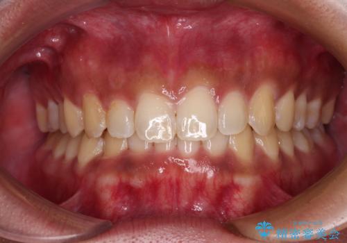 デコボコとディープバイトを治したい インビザラインによる矯正治療の症例 治療後