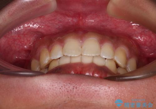 デコボコとディープバイトを治したい インビザラインによる矯正治療の治療後