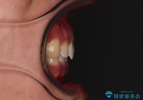 デコボコとディープバイトを治したい インビザラインによる矯正治療の治療後