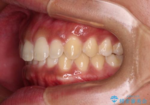 デコボコとディープバイトを治したい インビザラインによる矯正治療の治療後