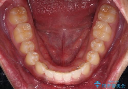 デコボコとディープバイトを治したい インビザラインによる矯正治療の治療後