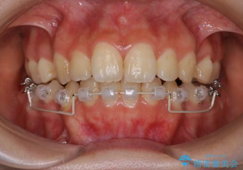 【ハーフリンガル】口元を下げたい!の治療中