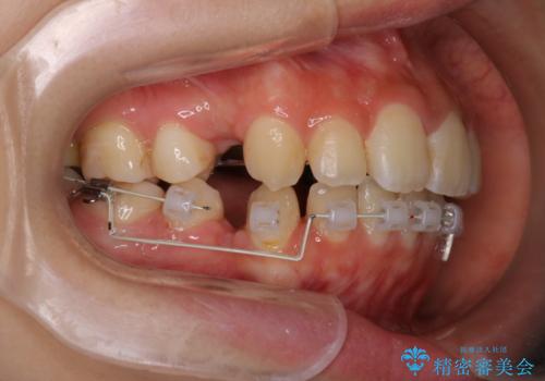 【ハーフリンガル】口元を下げたい!の治療中