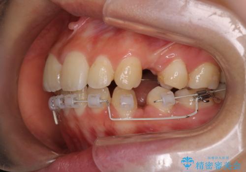 【ハーフリンガル】口元を下げたい!の治療中