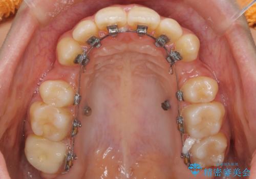 【ハーフリンガル】口元を下げたい!の治療中