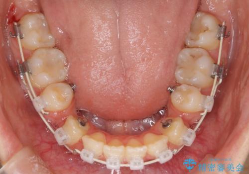 【ハーフリンガル】口元を下げたい!の治療中