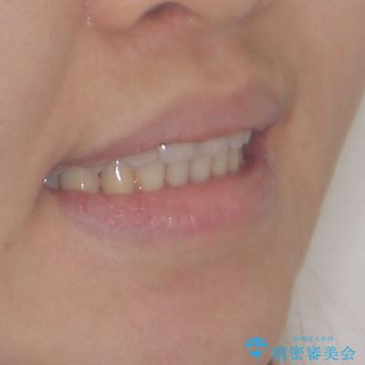 前歯の反対咬合　急速拡大装置とワイヤー装置であっという間の矯正治療の治療後（顔貌）