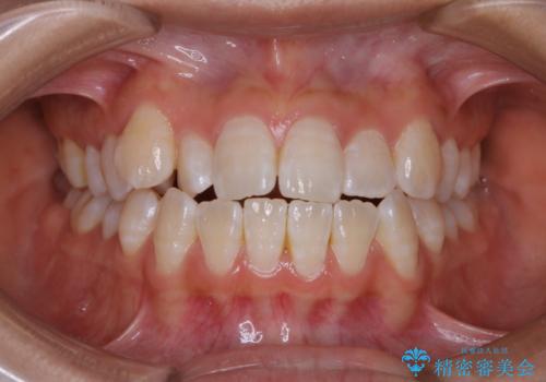前歯のがたつきとオープンバイト:インビザラインでまとめて治すの症例 治療前