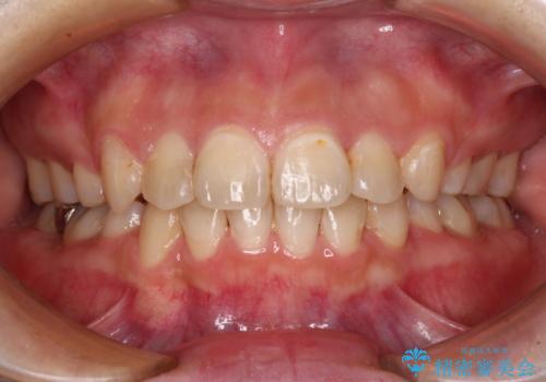 見えないほど重なっている前歯　抜歯矯正でスッキリとした歯並びにの症例 治療後